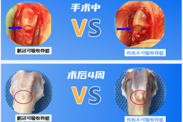 国内零突破，直击770 万台骨科手术刚需